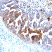 FFPE human ovarian carcinoma sections stained with 100 ul anti-TAG-72 / CA72.4 (clone B72.3 + CC49) at 1:300. HIER epitope retrieval prior to staining was performed in 10mM Citrate, pH 6.0.